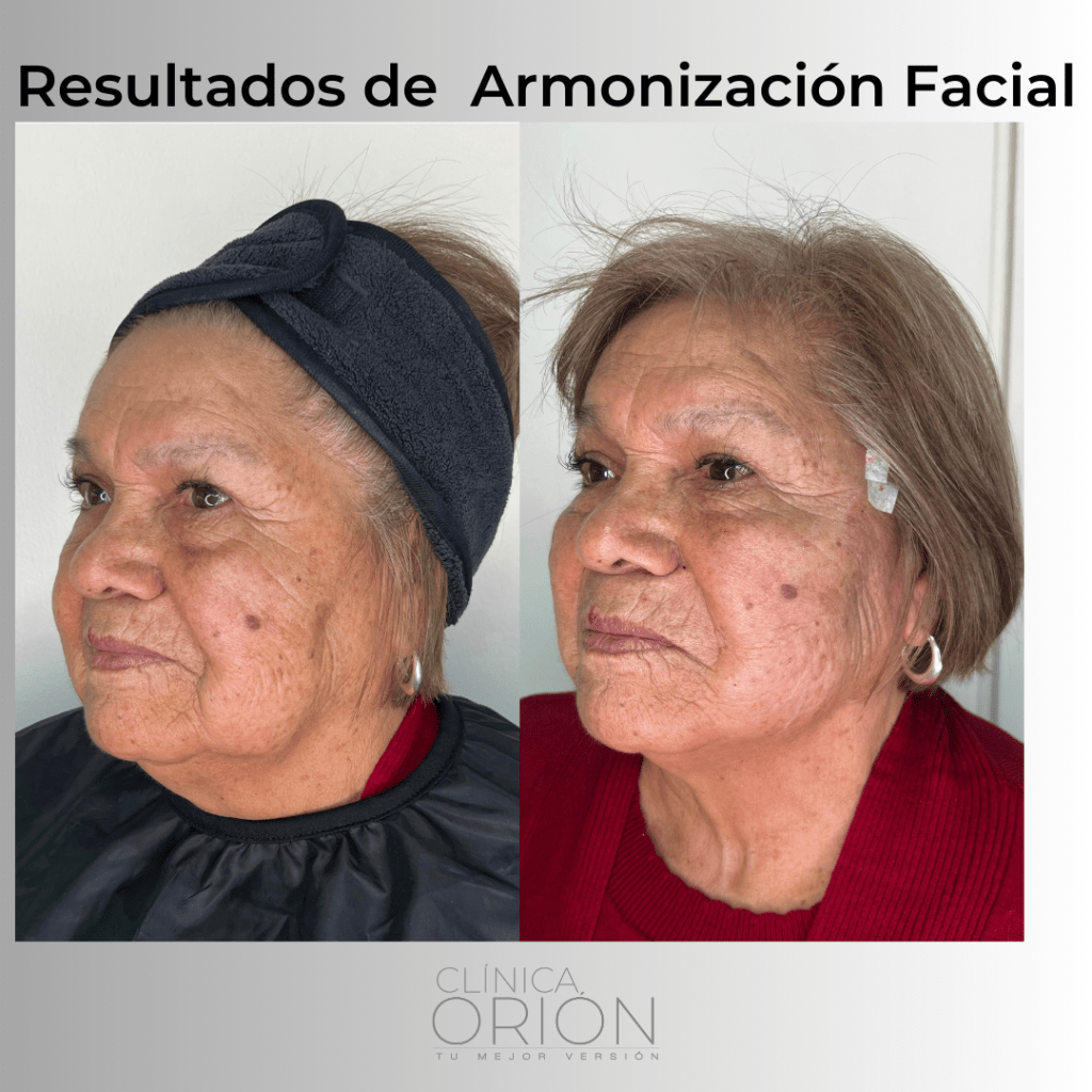 Armonización Facial Desde – Clínica Orion