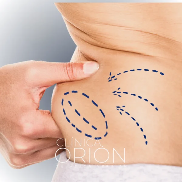 Lipoabdominoplastia